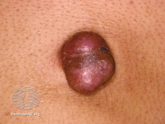 File:Dermatofibrosarcoma protuberans (DermNet NZ lesions-dfsp).jpg