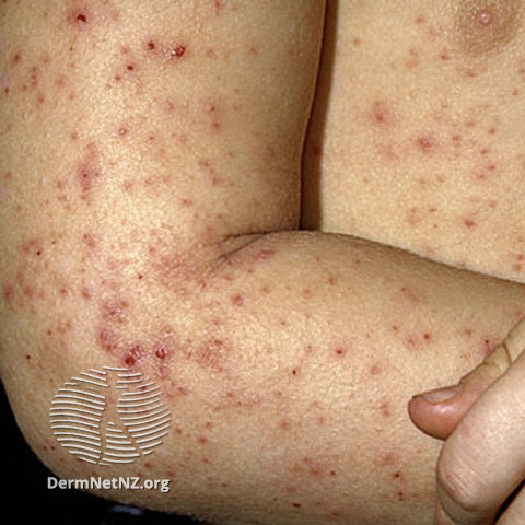 File:Follicular eczema (DermNet NZ dermatitis-s-atopic20).jpg