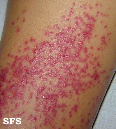 File:Folliculitis (Dermatology Atlas 2).jpg