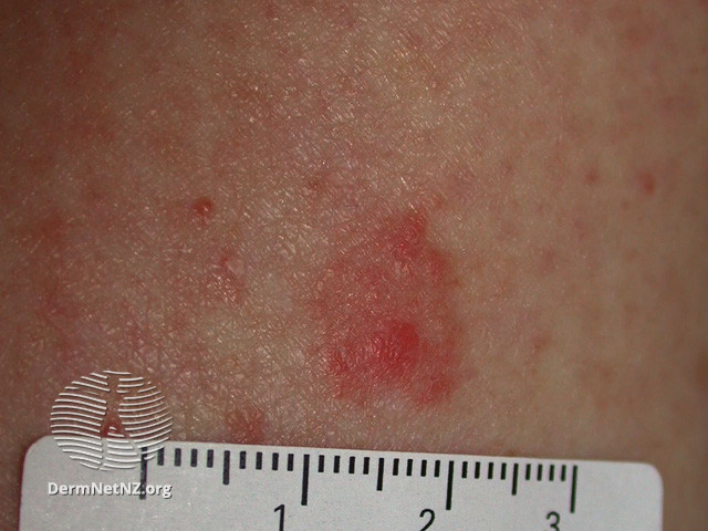 File:Intraepidermal carcinoma (DermNet NZ lesions-scc-in-situ-2942).jpg