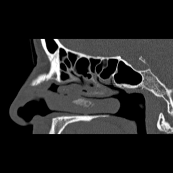 Nasal septal perforation (Radiopaedia 25030-25289 Sagittal bone window 20).jpg