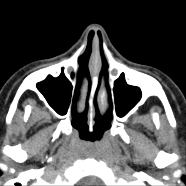 Nasolabial cyst (Radiopaedia 33987-35205 Axial non-contrast 20).jpg