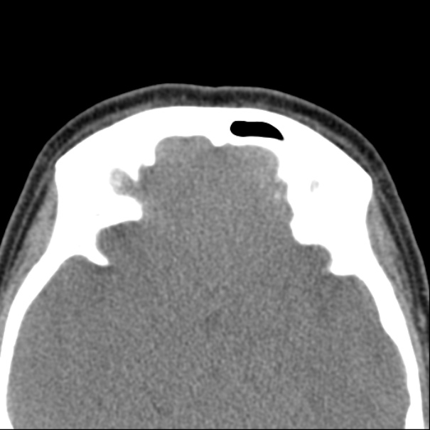 Nasolabial cyst (Radiopaedia 33987-35205 Axial non-contrast 46).jpg