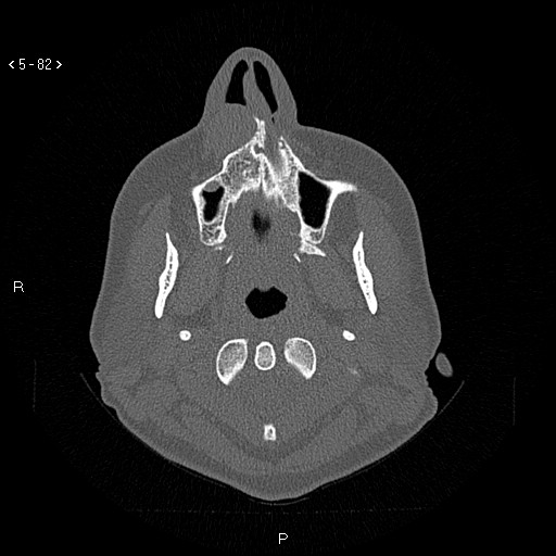 Nasolabial cyst (Radiopaedia 75125-86194 Axial bone window 43).jpg