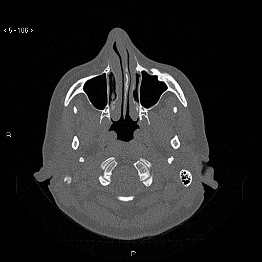 Nasolabial cyst (Radiopaedia 75125-86194 Axial bone window 67).jpg