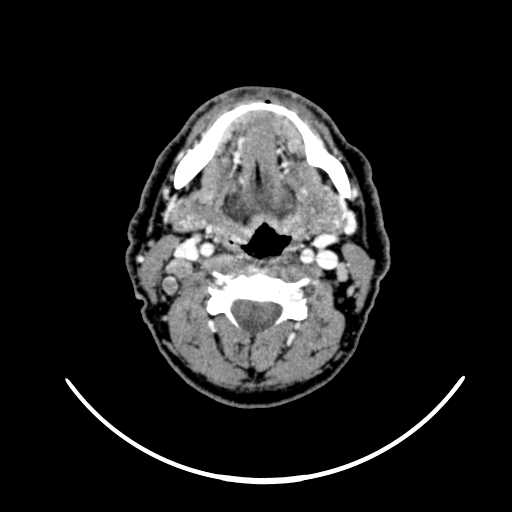 File:Nasopharyngeal carcinoma - infiltrating the clivus (Radiopaedia 62583-70875 Axial Post contrast 38).jpg