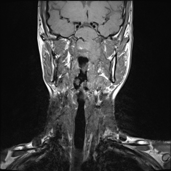 Nasopharyngeal carcinoma with skull base invasion (Radiopaedia 53415-59485 Coronal T1 22).jpg