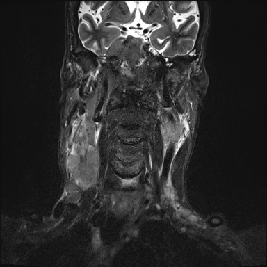 Nasopharyngeal carcinoma with skull base invasion (Radiopaedia 59258-66600 Coronal T2 fat sat 15).jpg