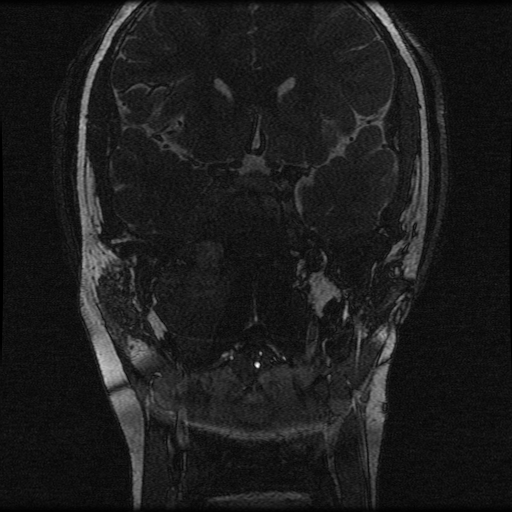 File:Nasopharyngeal rhabdomyosarcoma (Radiopaedia 23417-23486 F 3).jpg