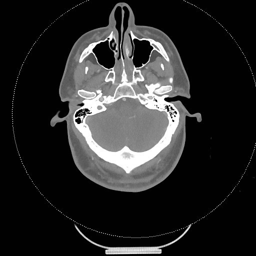 Neck CT angiogram (intraosseous vascular access) (Radiopaedia 55481-61945 B 264).jpg