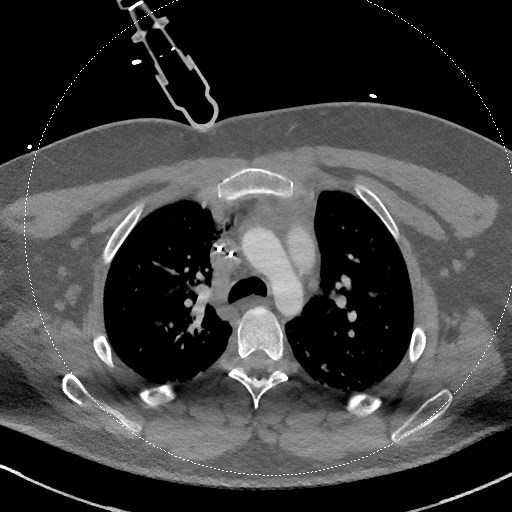 File:Neck CT angiogram (intraosseous vascular access) (Radiopaedia 55481-61945 B 48).jpg