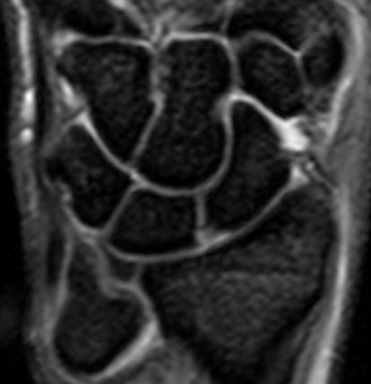 File:Negative ulnar variance (MRI) (Radiopaedia 14755).jpg