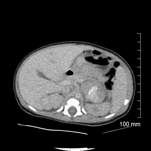 File:Neonatal neuroblastoma (Radiopaedia 56651-63438 Axial non-contrast 29).jpg