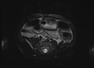Neonatal prostatic utricle abscess - cyst (Radiopaedia 69511-79394 Axial T2 fat sat 35).jpg
