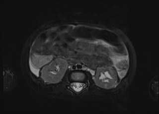 Neonatal prostatic utricle abscess - cyst (Radiopaedia 69511-79394 Axial T2 fat sat 43).jpg
