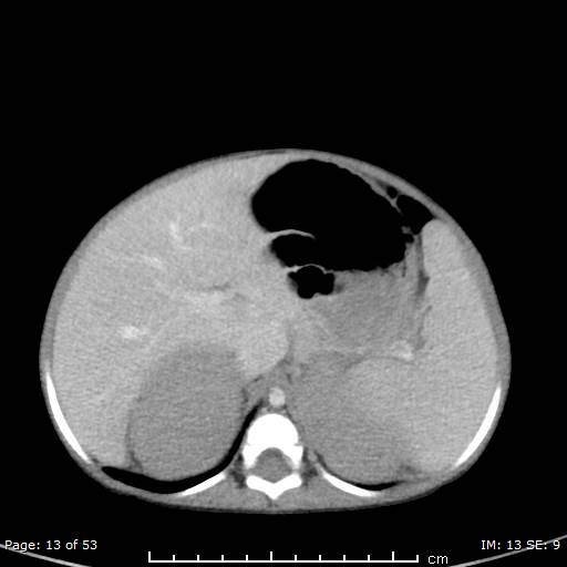 File:Nephroblastomatosis (Radiopaedia 41934-44935 A 13).jpg