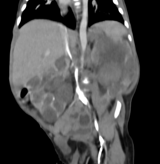 Nephroblastomatosis (Radiopaedia 71294-81607 B 206).jpg