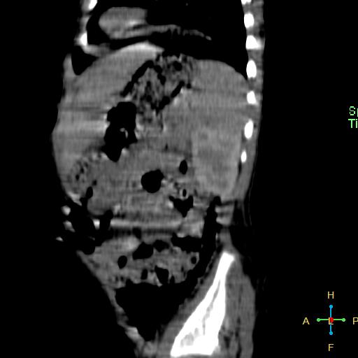 File:Neuroblastoma (Radiopaedia 24751-25016 C 6).jpg