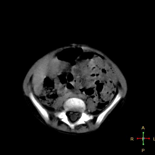File:Neuroblastoma (Radiopaedia 24751-25016 D 28).jpg