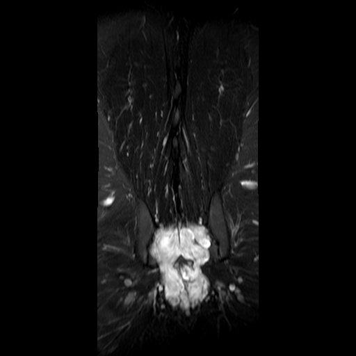 File:Neurofibromatosis type 1- extensive spinal involvement and Christmas tree sign (Radiopaedia 60610-68332 Coronal STIR 16).jpg