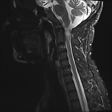 File:Neurofibromatosis type 1 (Radiopaedia 80355-93740 Sagittal STIR 5).jpg