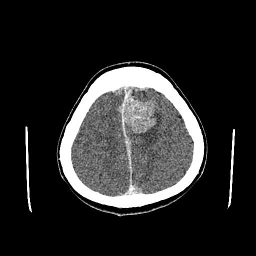 File:Neurofibromatosis type 2 (Radiopaedia 25389-25637 Axial C+ 82).jpg