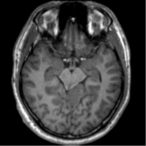 File:Neurofibromatosis type 2 (Radiopaedia 44936-48838 Axial T1 55).png