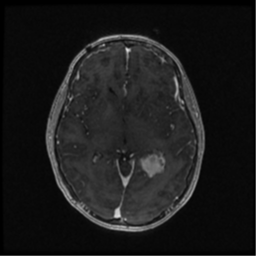 Neurofibromatosis type 2 (Radiopaedia 45229-49244 Axial T1 C+ 62).png