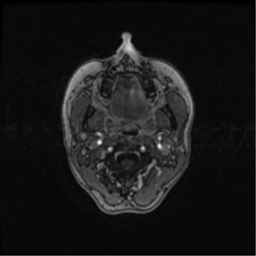 Neurofibromatosis type 2 (Radiopaedia 45229-49244 Axial T1 C+ 8).png