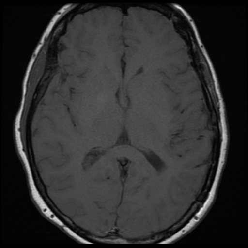 File:Neurofibromatosis type 2 (Radiopaedia 45229-49251 Axial T1 19).png