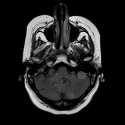File:Neurofibromatosis type 2 (Radiopaedia 8713-9518 Axial FLAIR 20).jpg