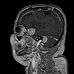 File:Neurofibromatosis type 2 (Radiopaedia 8713-9518 Sagittal T1 C+ 14).jpg