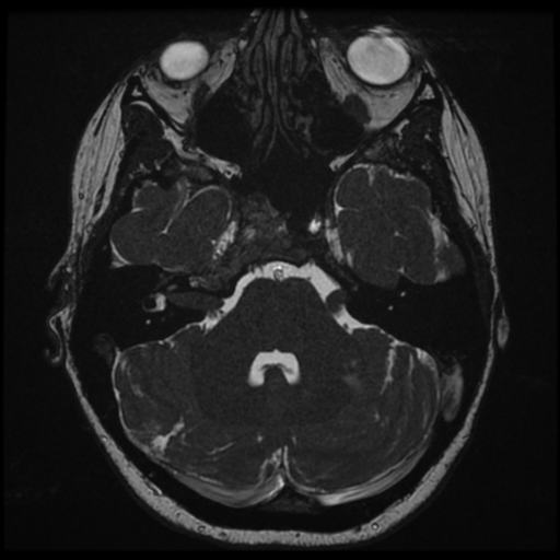 Neurofibromatosis type 2 - bilateral acoustic neuromata (Radiopaedia 40060-42566 Axial FIESTA 43).png