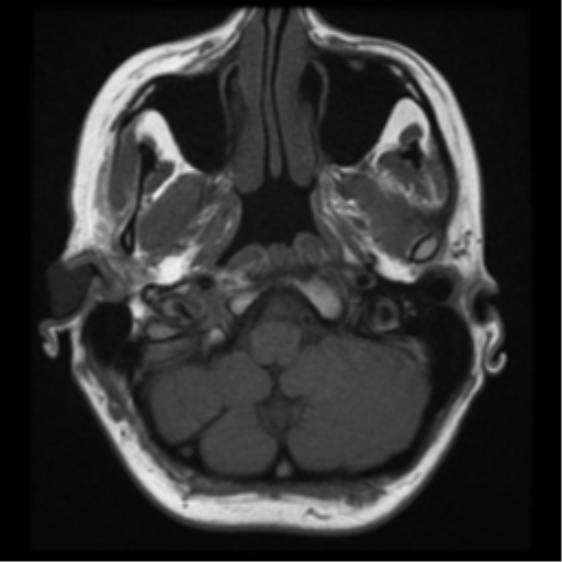 File:Neurofibromatosis type 2 - bilateral acoustic neuromata (Radiopaedia 40060-42566 Axial T1 3).png