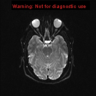 File:Neuroglial cyst (Radiopaedia 10713-11184 Axial DWI 15).jpg