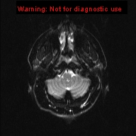 File:Neuroglial cyst (Radiopaedia 10713-11184 Axial DWI 20).jpg