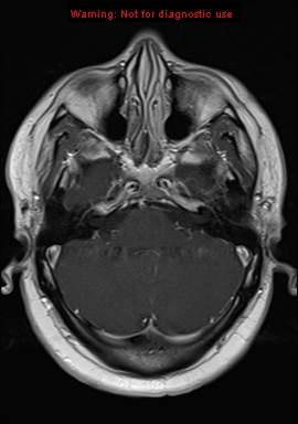File:Neuroglial cyst (Radiopaedia 10713-11184 Axial T1 C+ 18).jpg