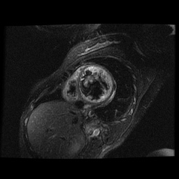 File:Non-compaction of the left ventricle (Radiopaedia 38868-41062 D 10).jpg