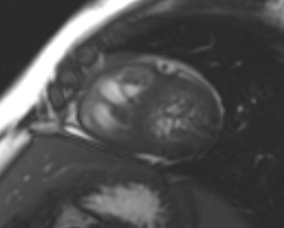 File:Non-compaction of the left ventricle (Radiopaedia 69436-79314 Short axis cine 87).jpg