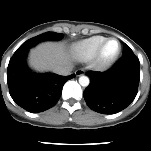 File:Non-small cell lung cancer with miliary metastases (Radiopaedia 23995-24193 A 33).jpg