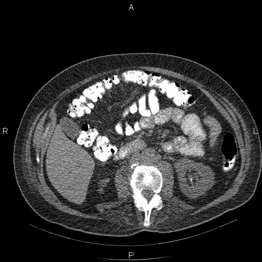 File:Non Hodgkin lymphoma in a patient with ankylosing spondylitis (Radiopaedia 84323-99624 Axial non-contrast 42).jpg