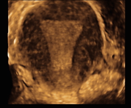 File:Normal 3D uterus (Radiopaedia 34301-35588 B 1).jpg