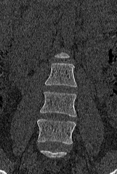 Normal CT lumbar spine (Radiopaedia 53981-60118 Coronal bone window 14).jpg