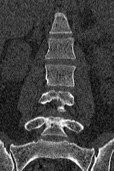 Normal CT lumbar spine (Radiopaedia 53981-60118 Coronal bone window 26).jpg