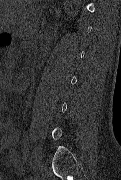 File:Normal CT lumbar spine (Radiopaedia 53981-60118 Sagittal bone window 73).jpg