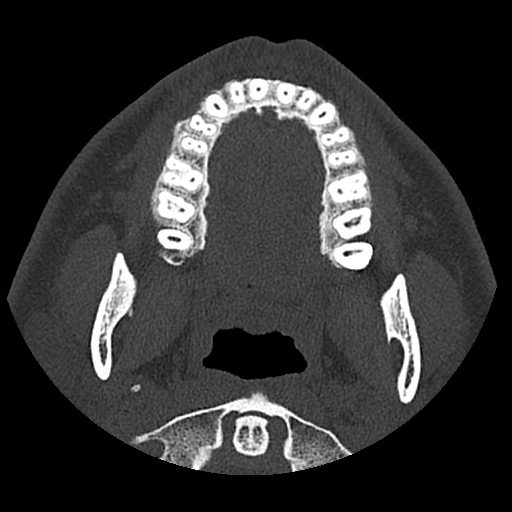 Normal CT paranasal sinuses (Radiopaedia 42286-45390 Axial bone window 106).jpg