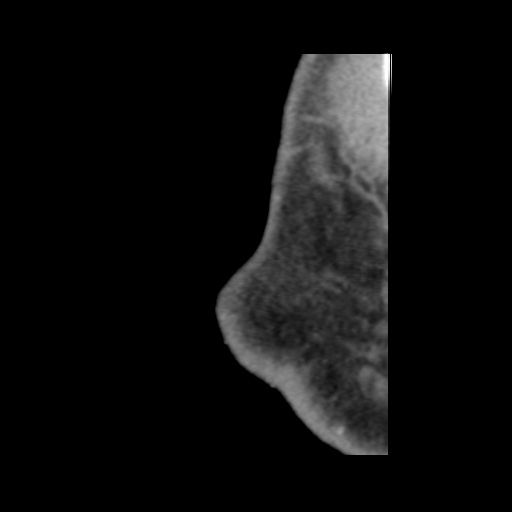 Normal CT paranasal sinuses (Radiopaedia 42286-45390 F 10).jpg