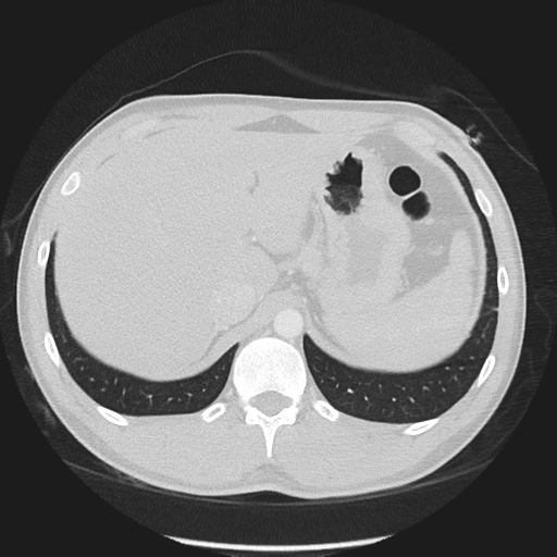 Normal CT pulmonary veins (pre RF ablation) (Radiopaedia 41748-44702 Axial lung window 68).png