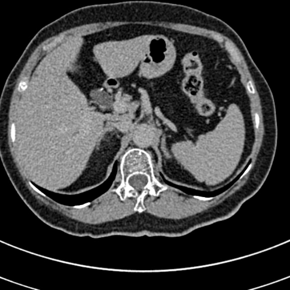 File:Normal CT split bolus study of the renal tract (Radiopaedia 48631-53634 Axial split bolus 17).jpg