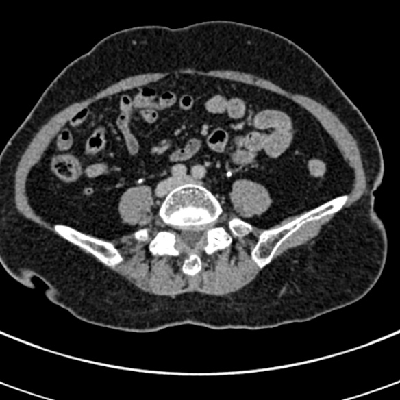 File:Normal CT split bolus study of the renal tract (Radiopaedia 48631-53634 Axial split bolus 177).jpg